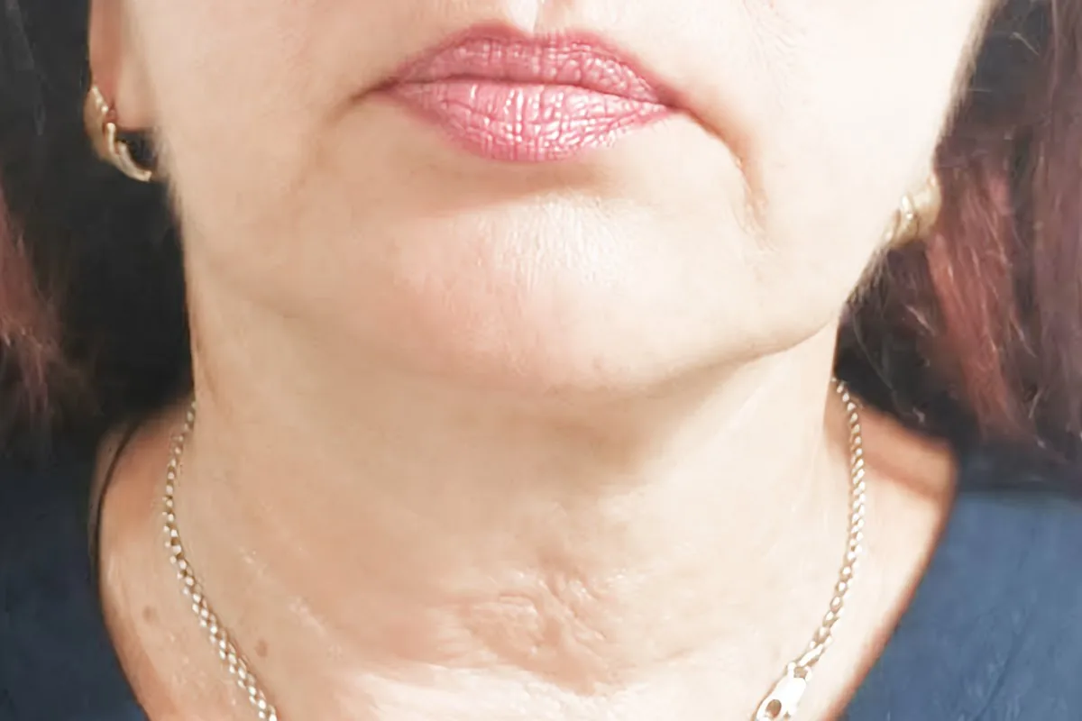 Neck and jawline after three F-HA Lift Fusion sessions