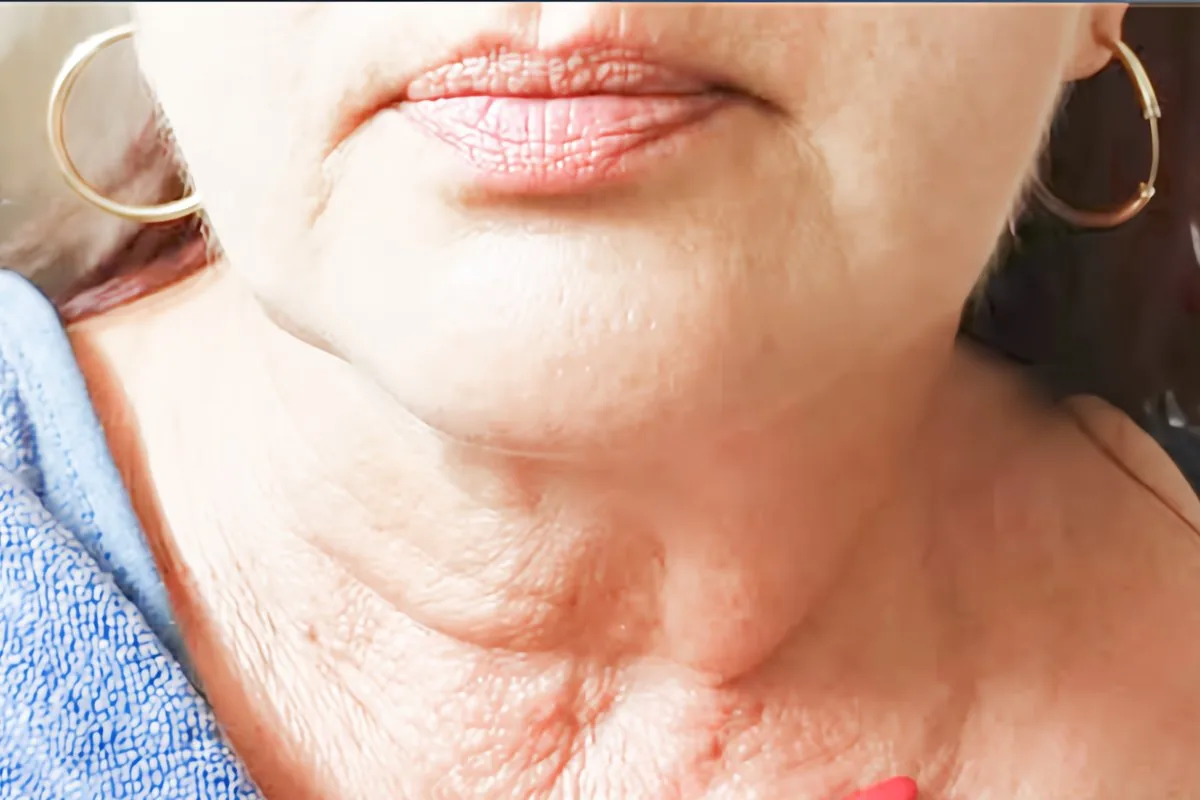 Neck and jawline before F-HA Lift Fusion treatment