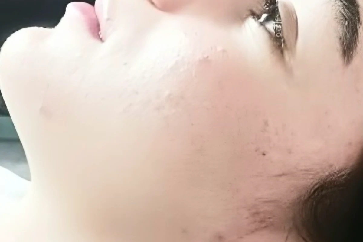 Calmer, clearer skin after Pure Skin Peel sessions