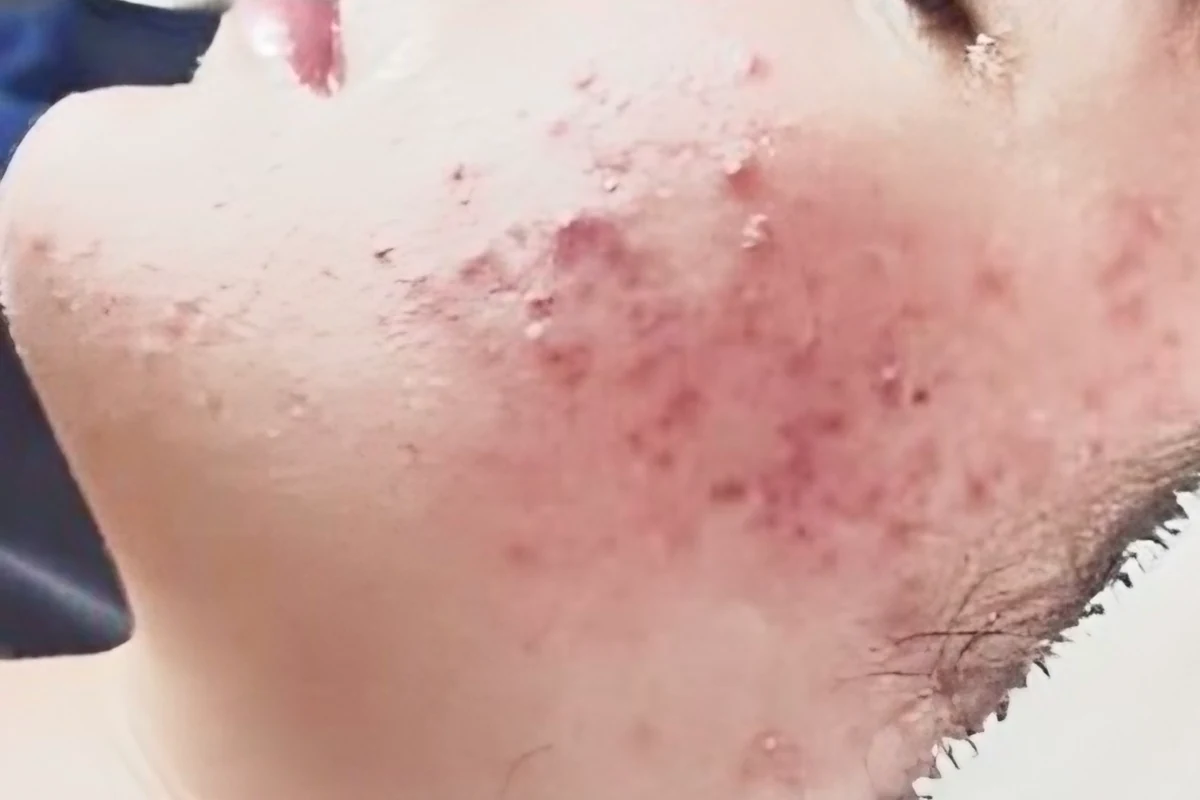 Skin with active acne before the Pure Skin Peel